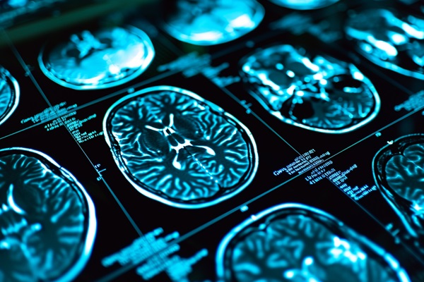 A series of high-contrast blue MRI brain scans displayed on a dark background, showing cross-sectional views used to diagnose traumatic brain injuries.